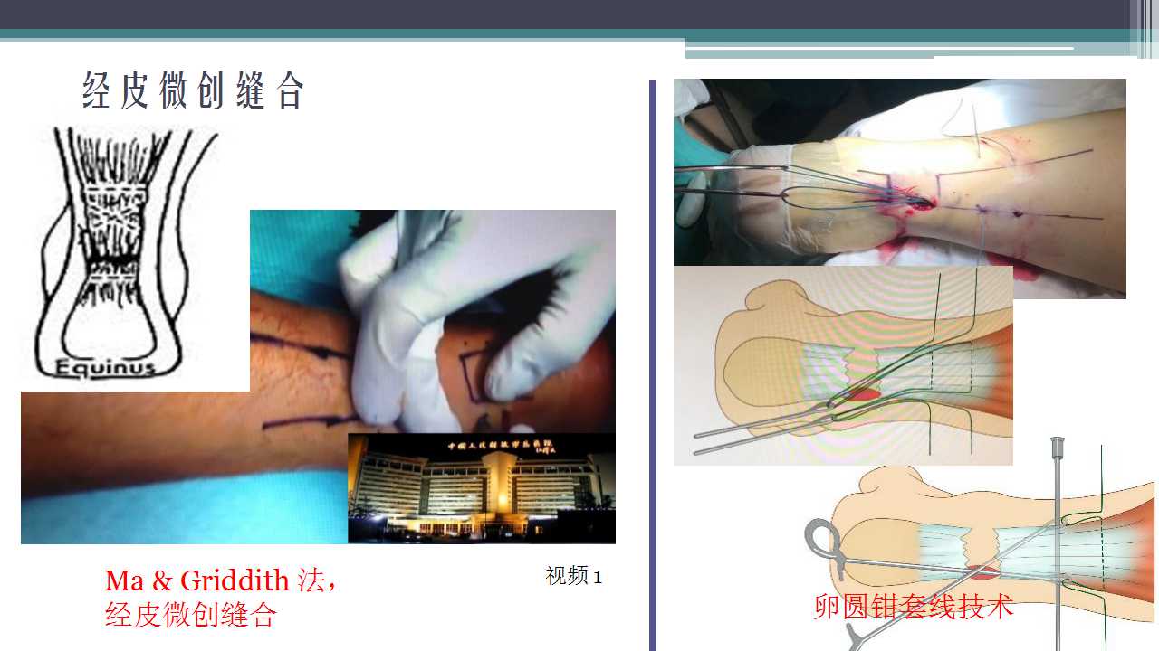 跟腱断裂治疗存在的问题及解决策略