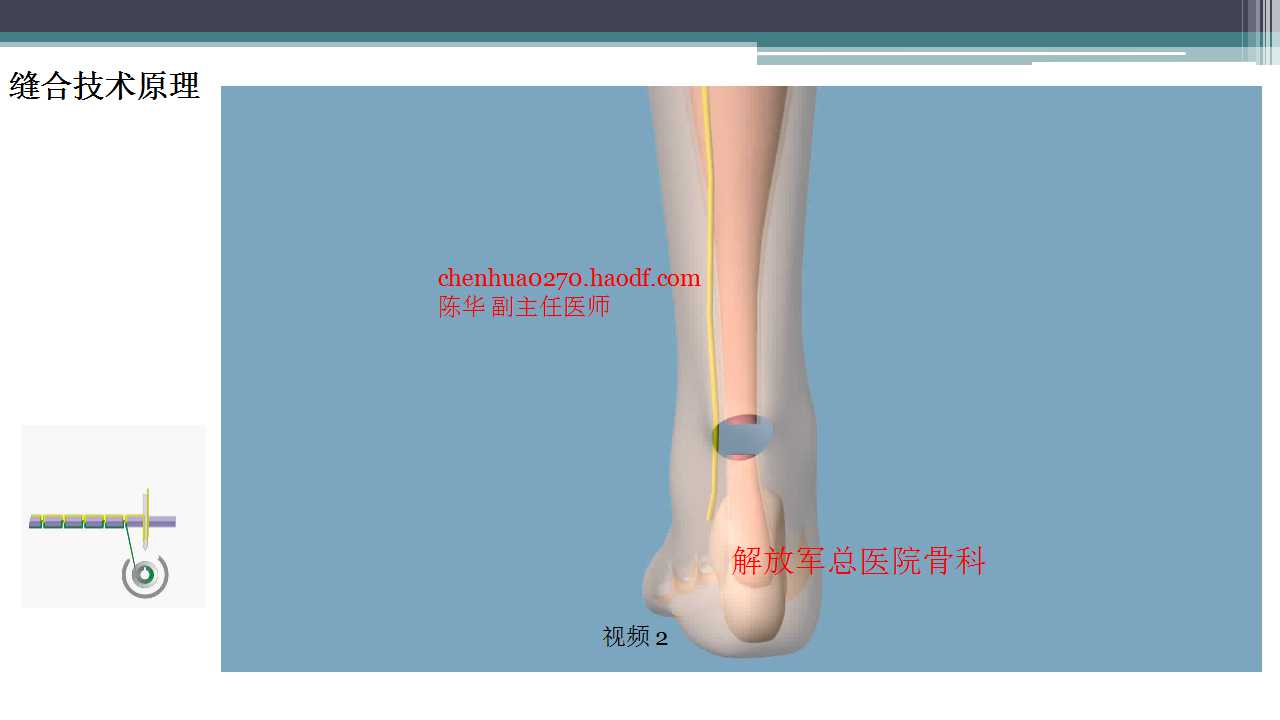 跟腱断裂治疗存在的问题及解决策略