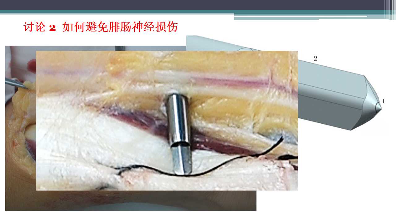 跟腱断裂治疗存在的问题及解决策略