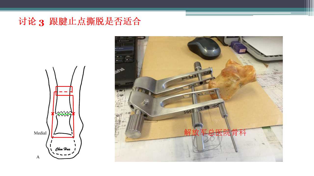 跟腱断裂治疗存在的问题及解决策略