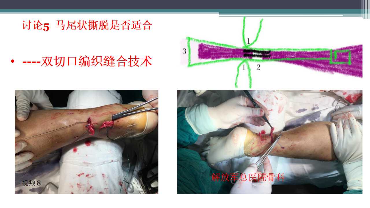 跟腱断裂治疗存在的问题及解决策略