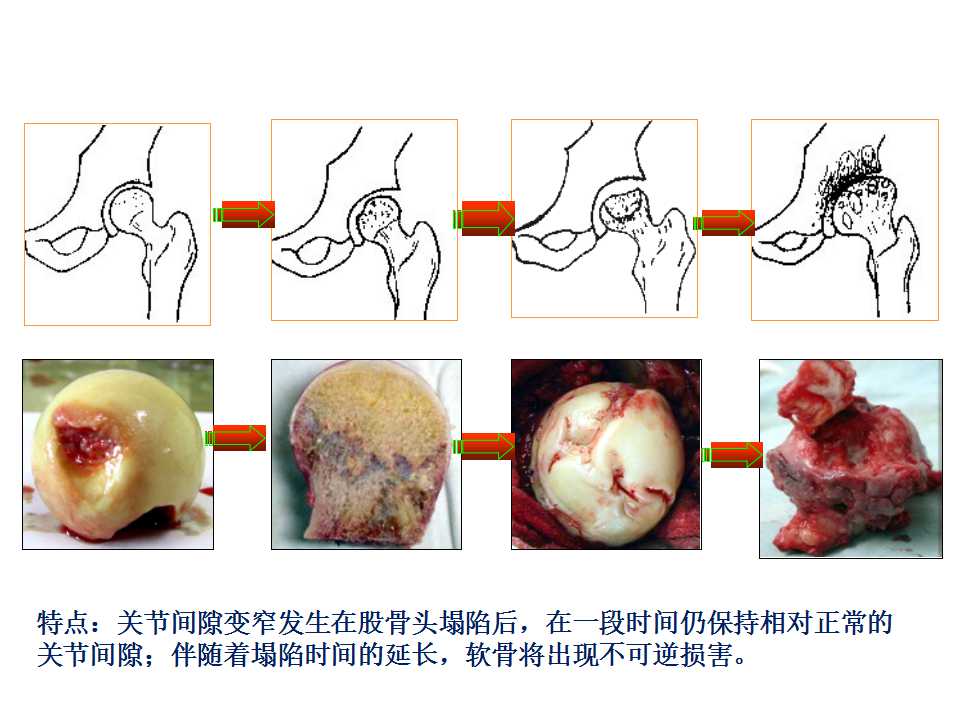 股骨头坏死的诊断与保髋方法的选择