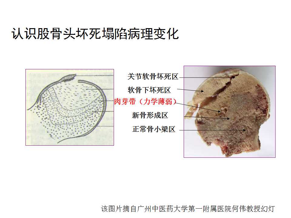 股骨头坏死的诊断与保髋方法的选择