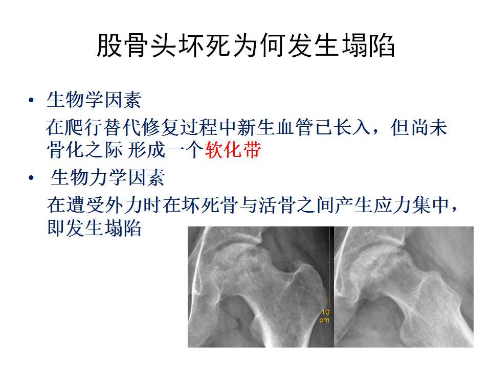 股骨头坏死的诊断与保髋方法的选择