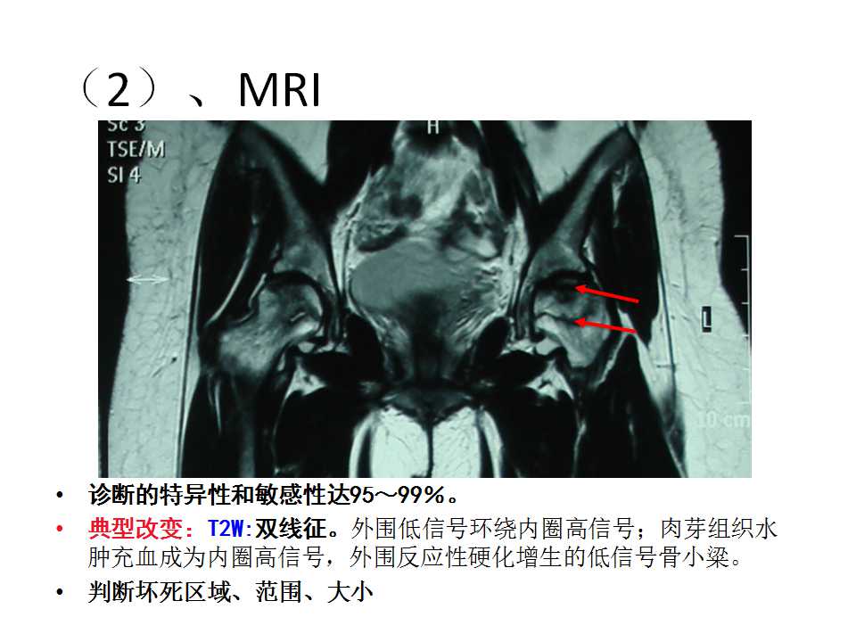 股骨头坏死的诊断与保髋方法的选择