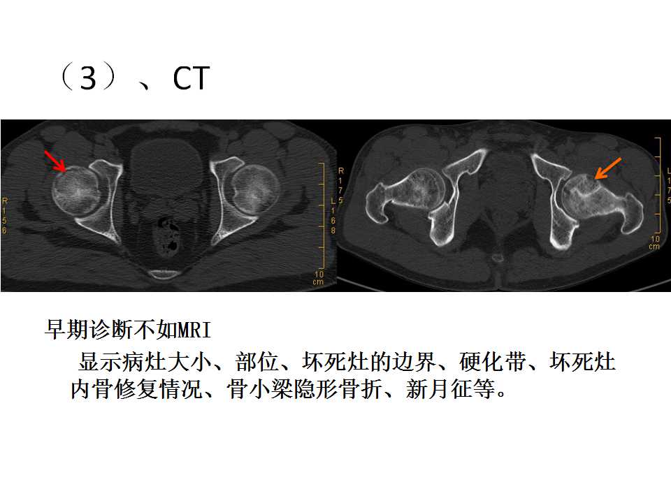 股骨头坏死的诊断与保髋方法的选择