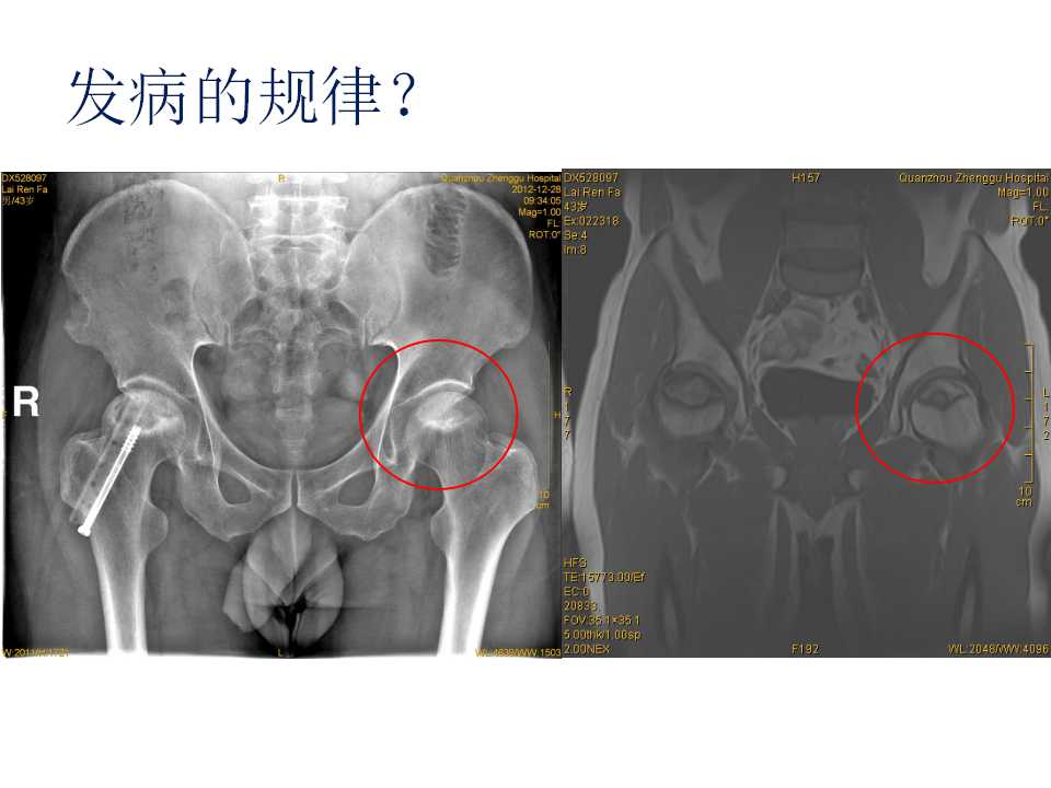 股骨头坏死的诊断与保髋方法的选择