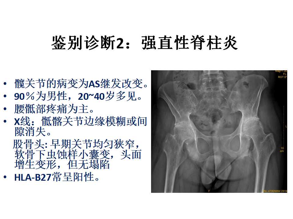 股骨头坏死的诊断与保髋方法的选择