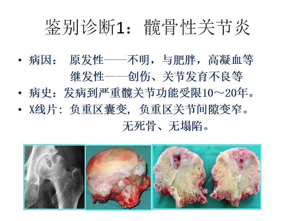 股骨头坏死的诊断与保髋方法的选择