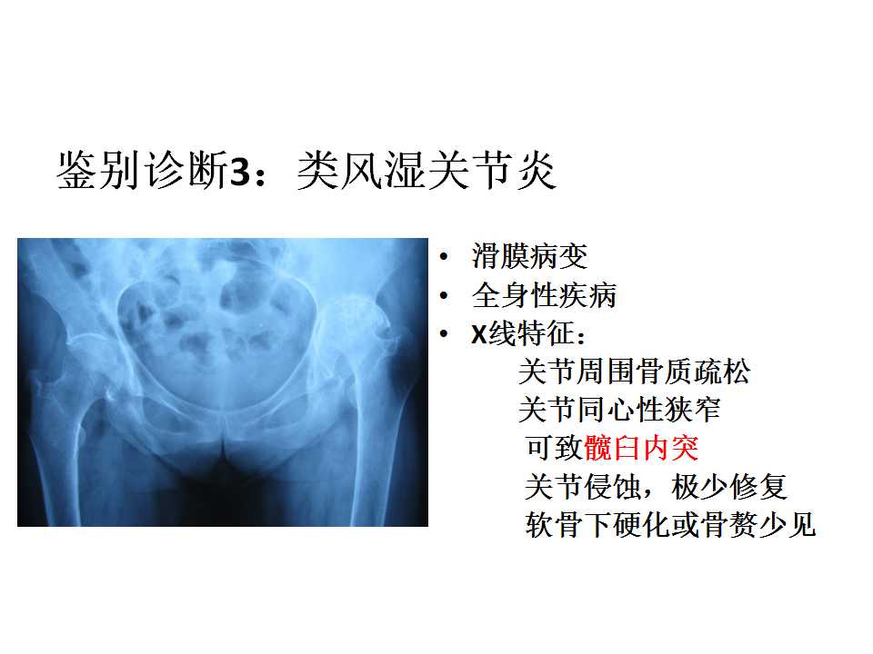 股骨头坏死的诊断与保髋方法的选择