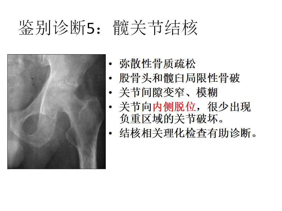 股骨头坏死的诊断与保髋方法的选择