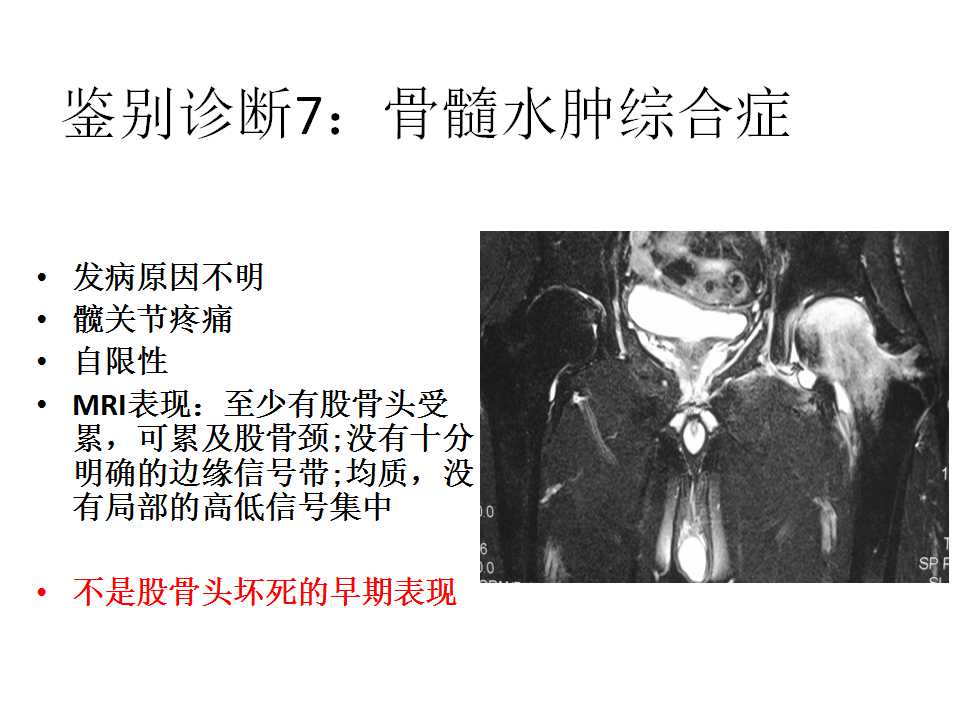 股骨头坏死的诊断与保髋方法的选择