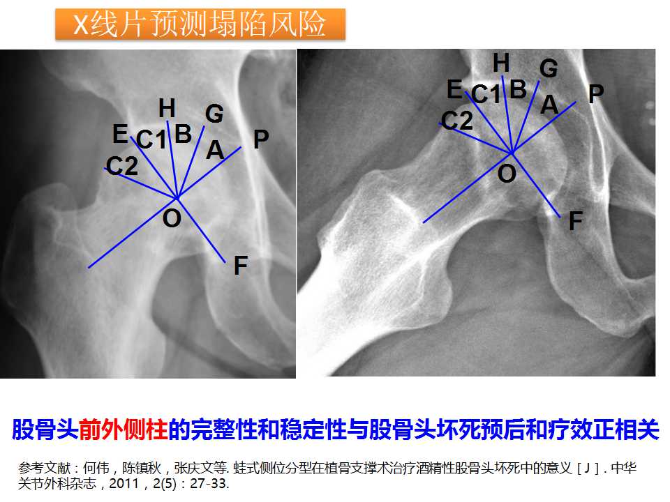 股骨头坏死的诊断与保髋方法的选择