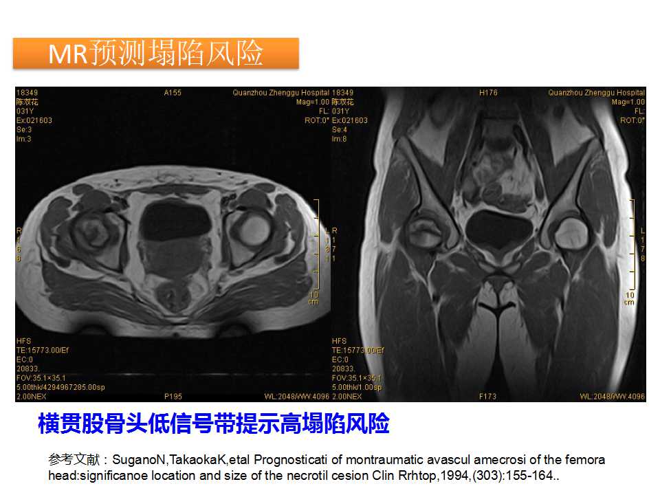 股骨头坏死的诊断与保髋方法的选择