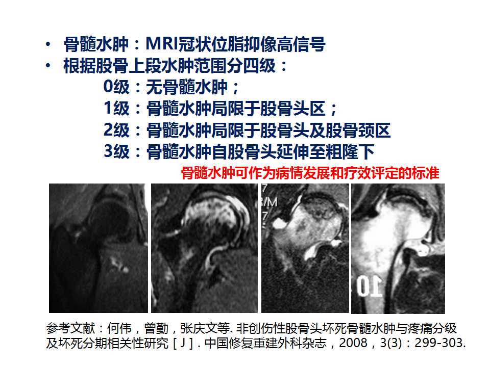 股骨头坏死的诊断与保髋方法的选择