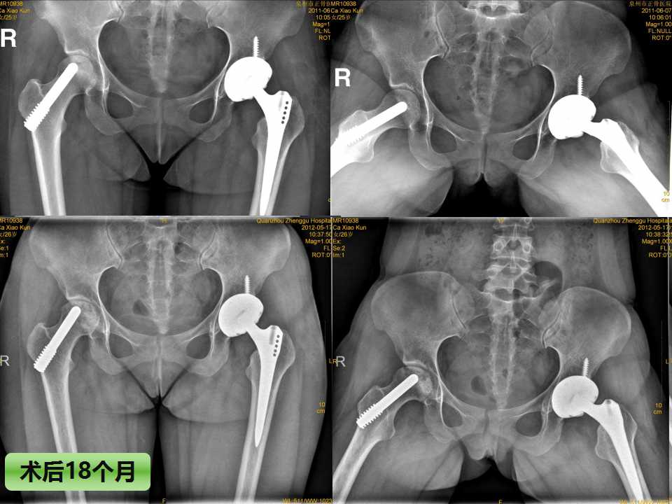 股骨头坏死的诊断与保髋方法的选择