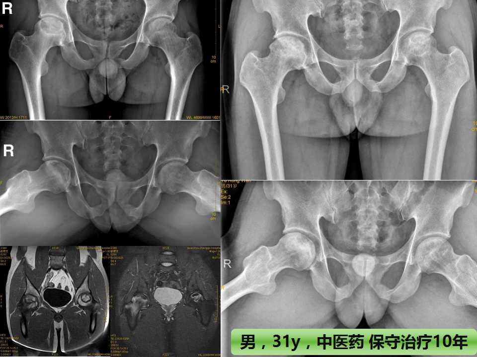 股骨头坏死的诊断与保髋方法的选择