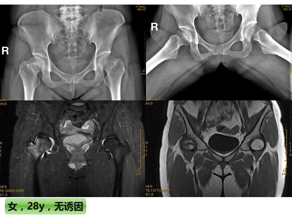 股骨头坏死的诊断与保髋方法的选择