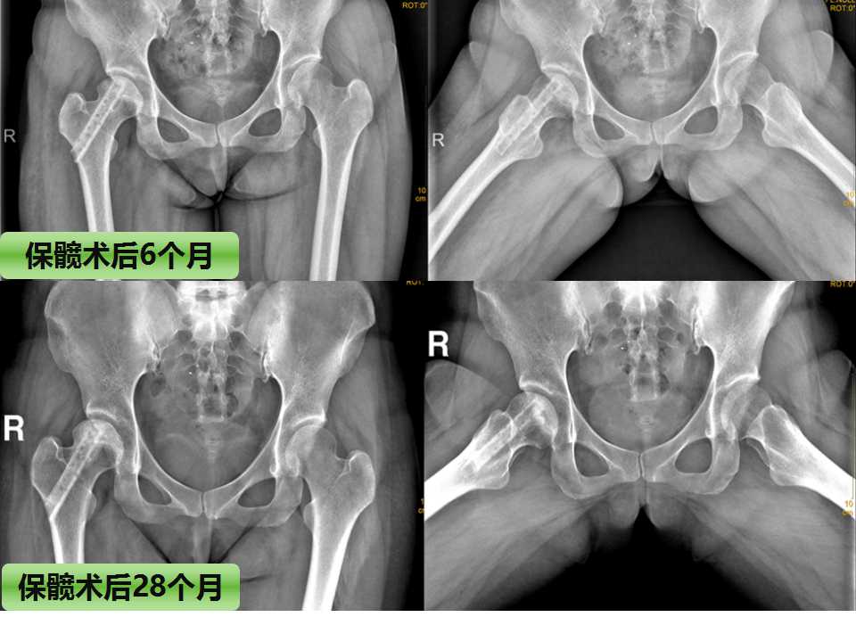 股骨头坏死的诊断与保髋方法的选择