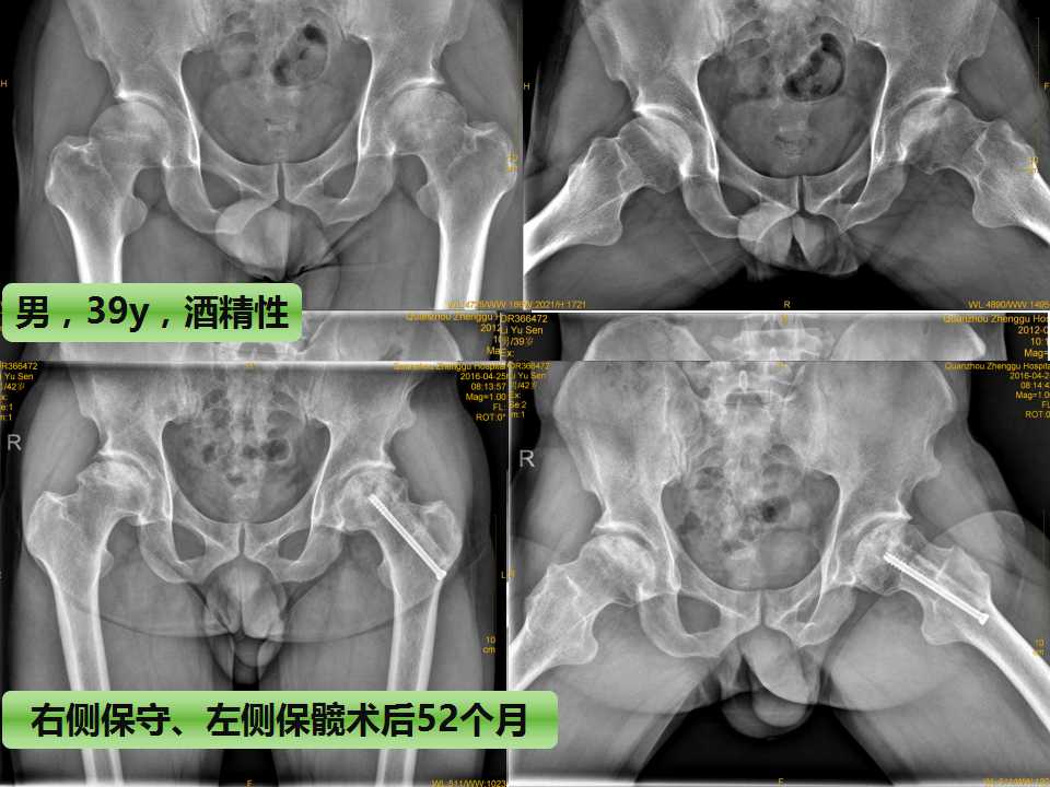 股骨头坏死的诊断与保髋方法的选择