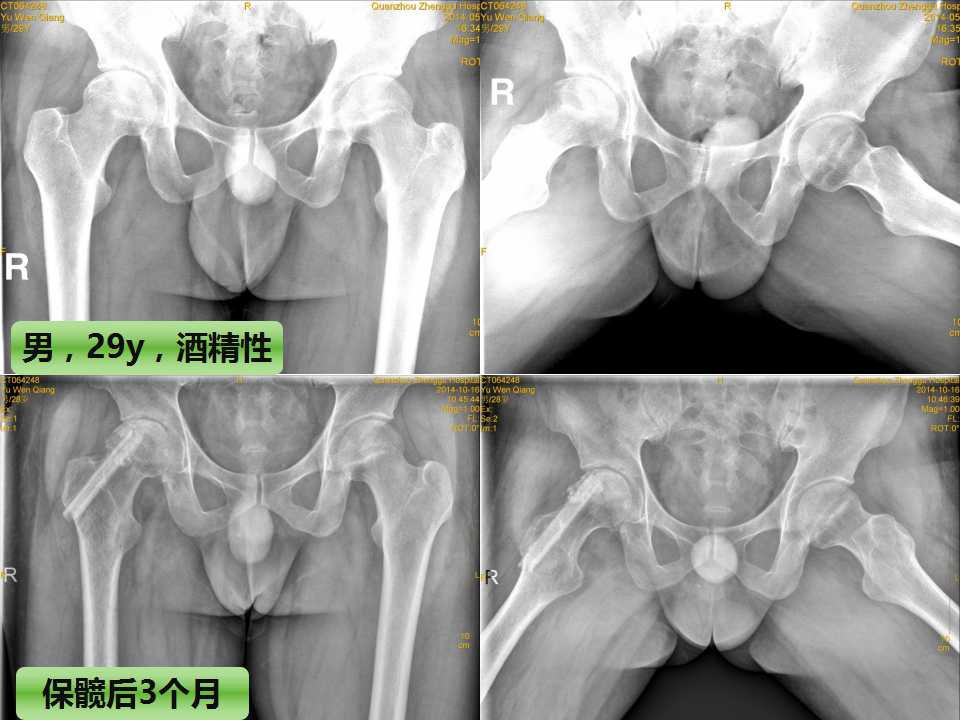 股骨头坏死的诊断与保髋方法的选择