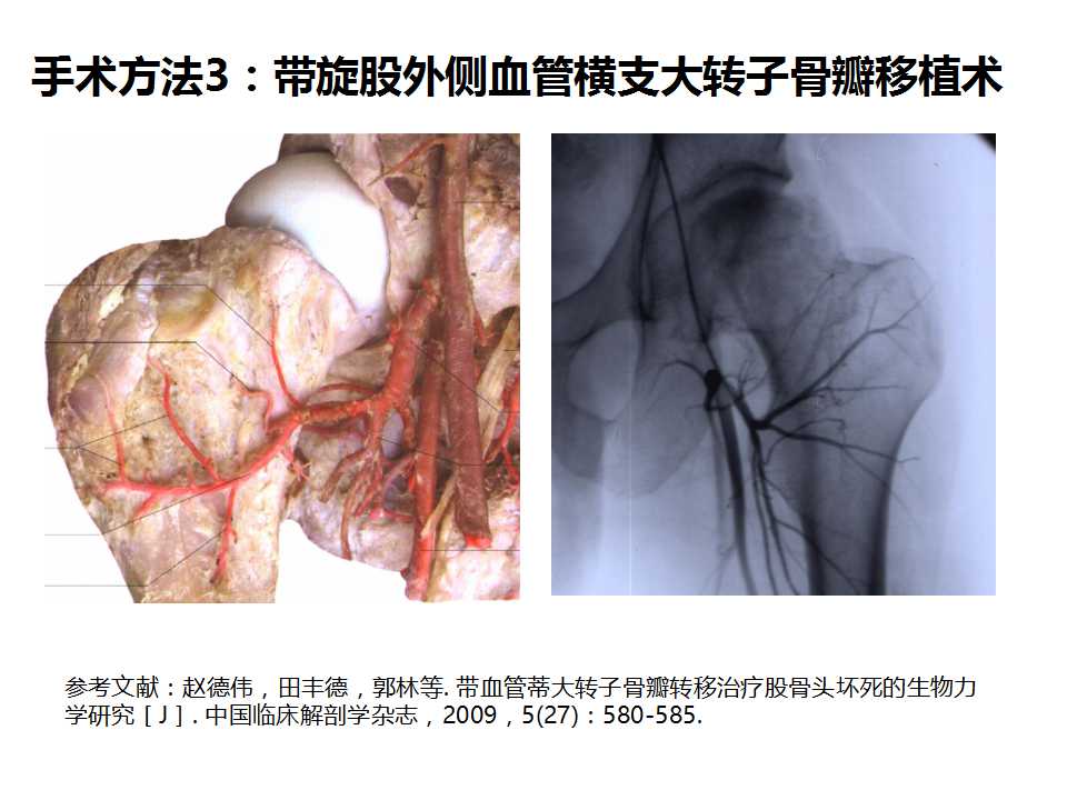 股骨头坏死的诊断与保髋方法的选择