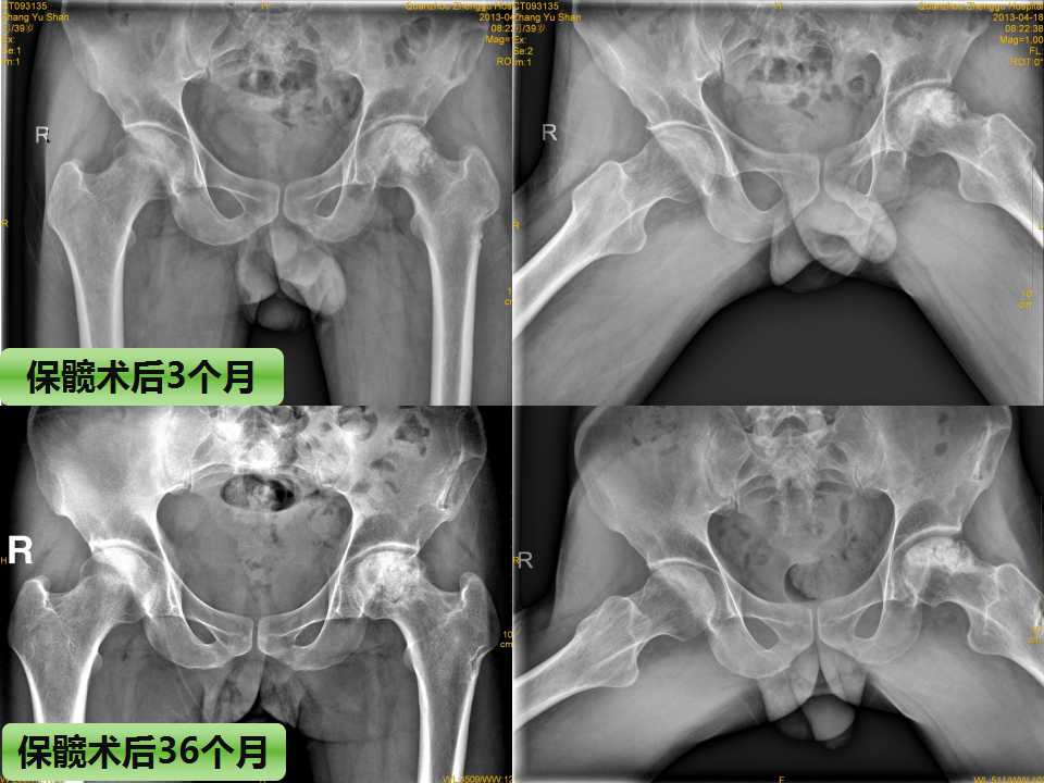 股骨头坏死的诊断与保髋方法的选择