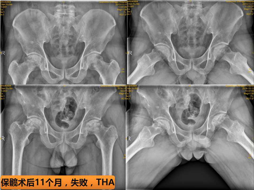 股骨头坏死的诊断与保髋方法的选择