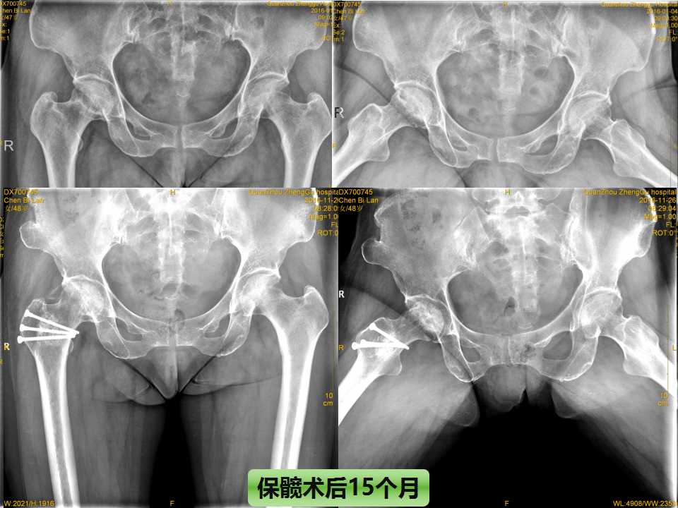 股骨头坏死的诊断与保髋方法的选择