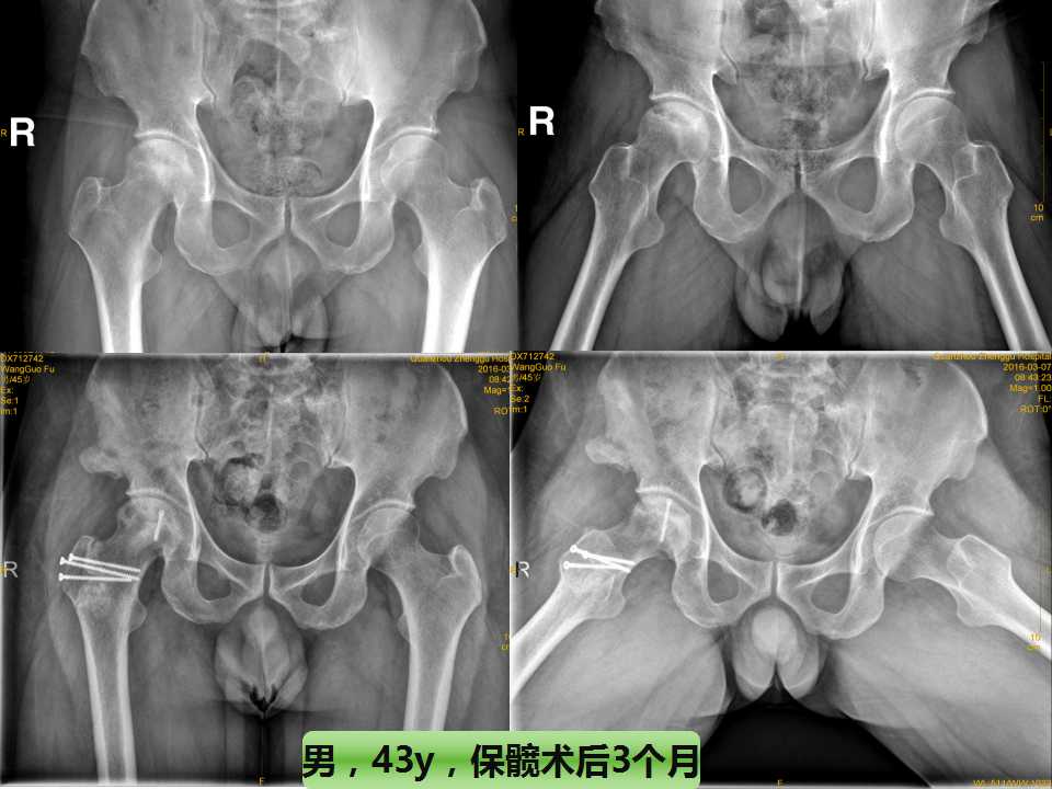 股骨头坏死的诊断与保髋方法的选择