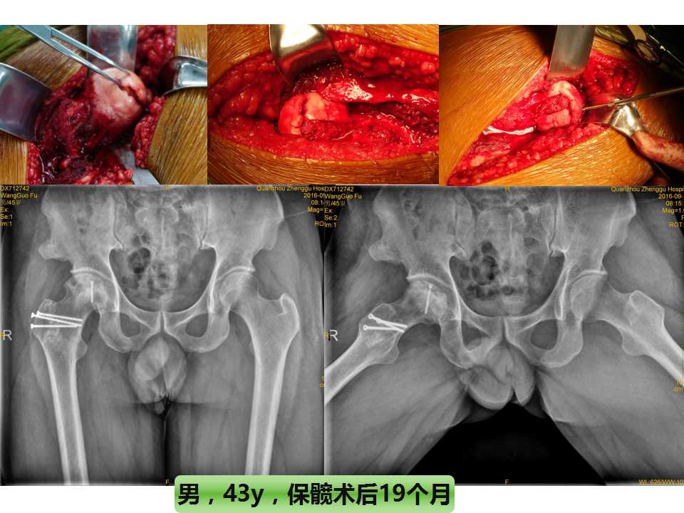 股骨头坏死的诊断与保髋方法的选择