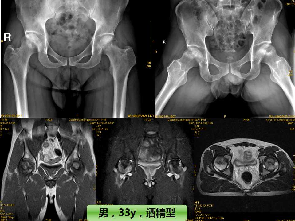 股骨头坏死的诊断与保髋方法的选择