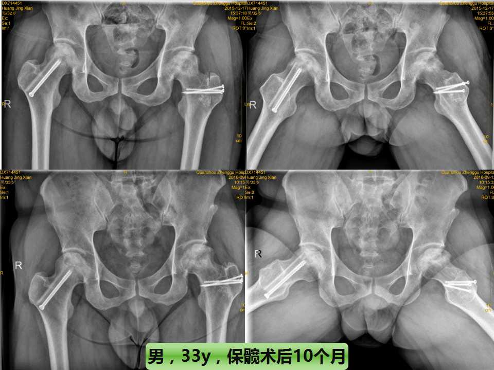 股骨头坏死的诊断与保髋方法的选择