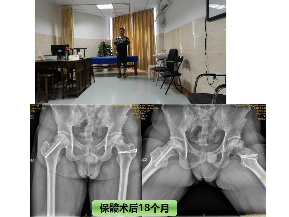 股骨头坏死的诊断与保髋方法的选择