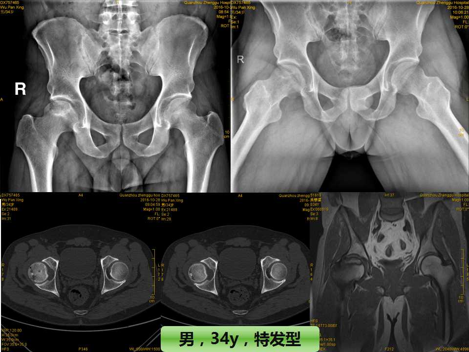 股骨头坏死的诊断与保髋方法的选择