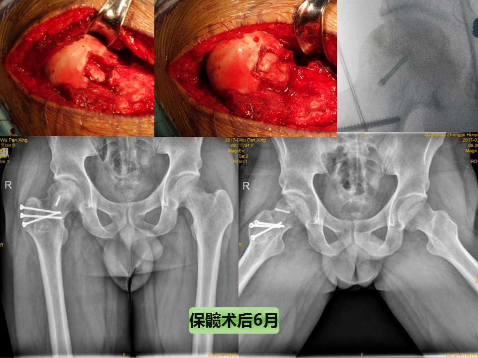 股骨头坏死的诊断与保髋方法的选择