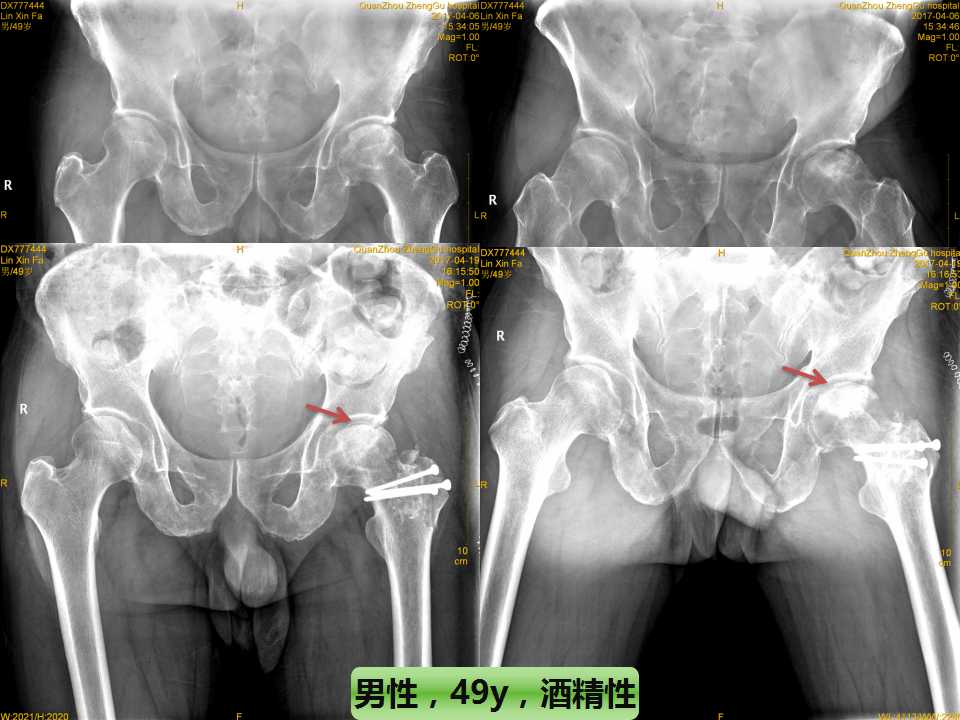 股骨头坏死的诊断与保髋方法的选择