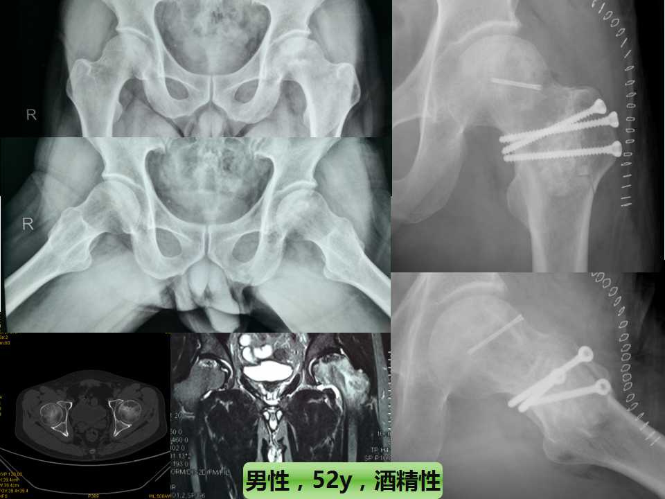 股骨头坏死的诊断与保髋方法的选择