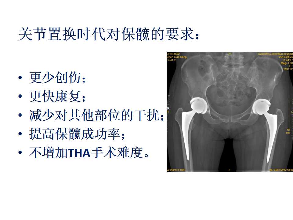 股骨头坏死的诊断与保髋方法的选择