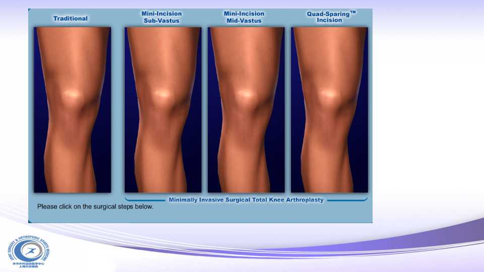 全膝关节置换的微创技术与技巧