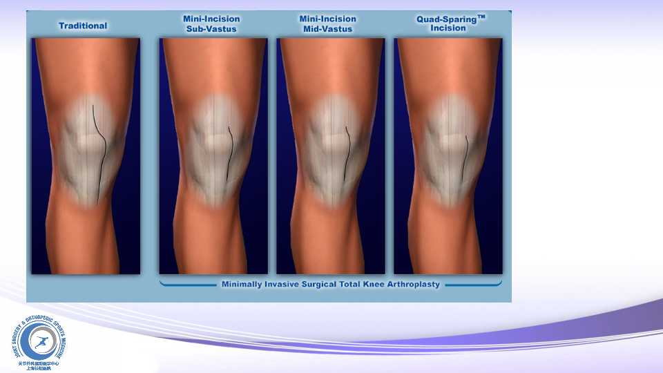全膝关节置换的微创技术与技巧
