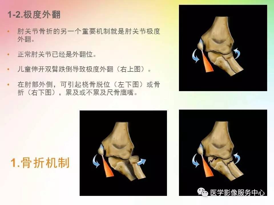 儿童肘关节骨折的分类与诊断要点