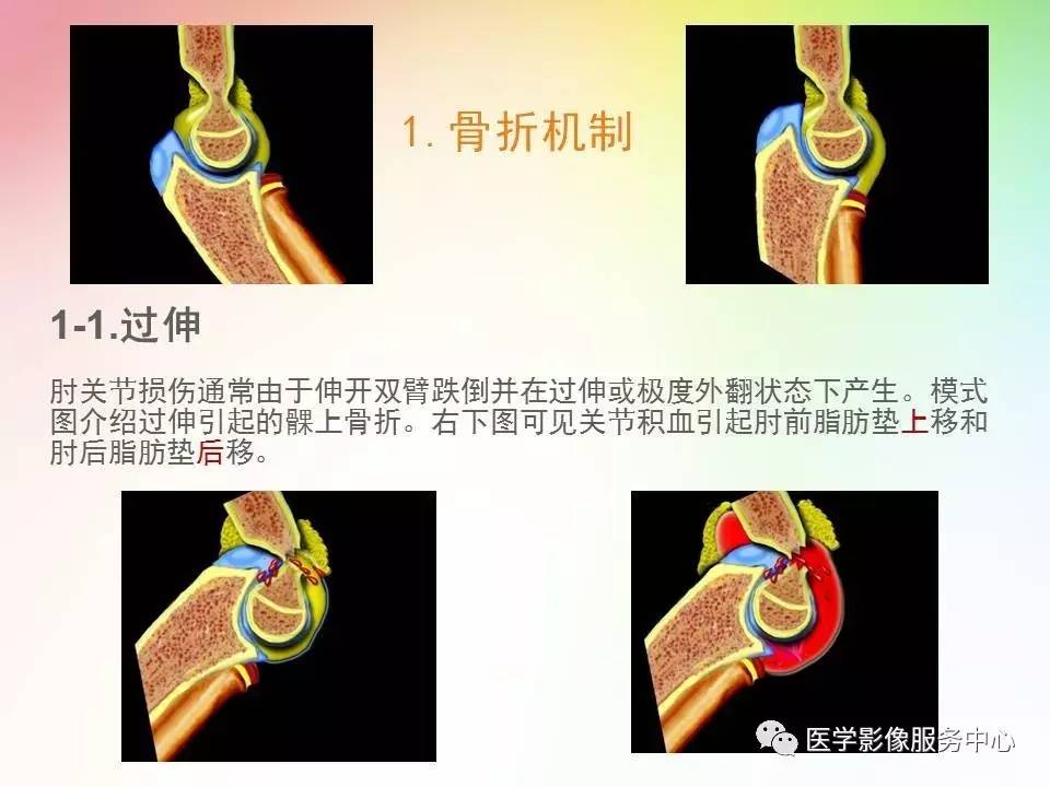 儿童肘关节骨折的分类与诊断要点