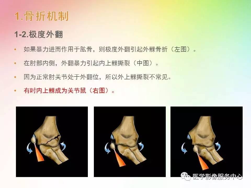 儿童肘关节骨折的分类与诊断要点