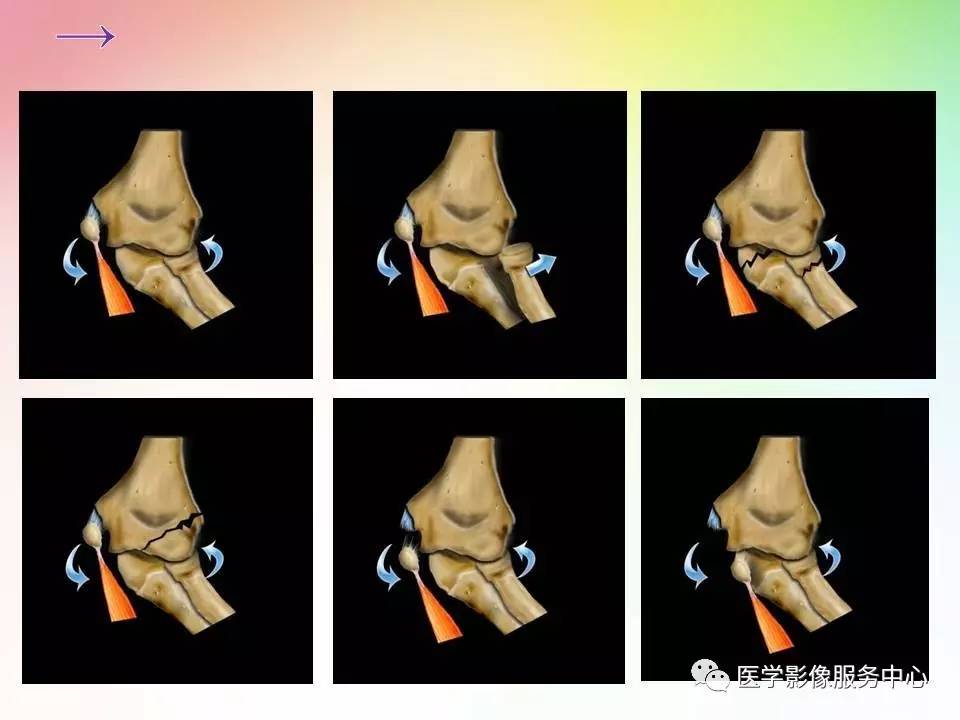儿童肘关节骨折的分类与诊断要点