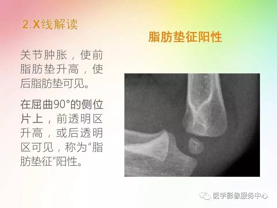 儿童肘关节骨折的分类与诊断要点