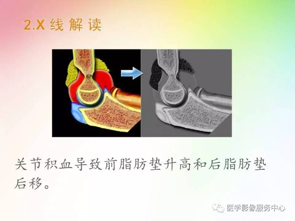 儿童肘关节骨折的分类与诊断要点