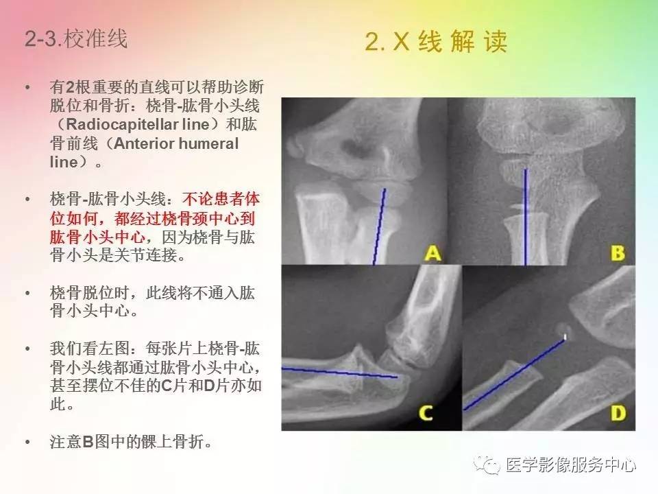 儿童肘关节骨折的分类与诊断要点