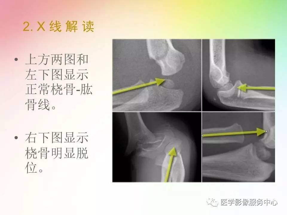 儿童肘关节骨折的分类与诊断要点