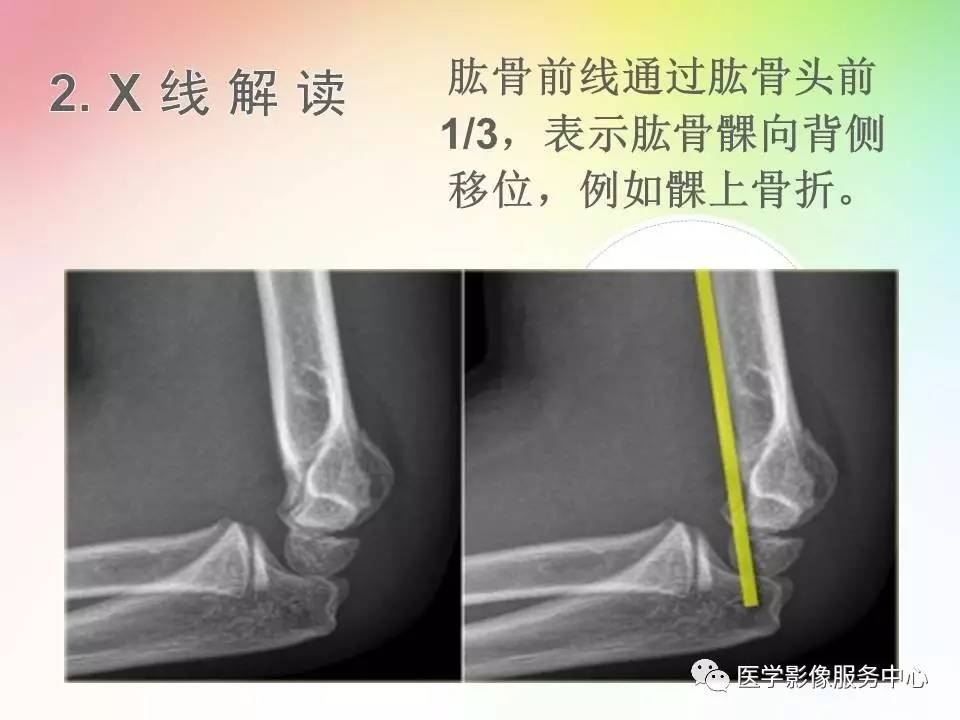 儿童肘关节骨折的分类与诊断要点